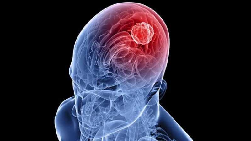 O que é Tumor cerebral?